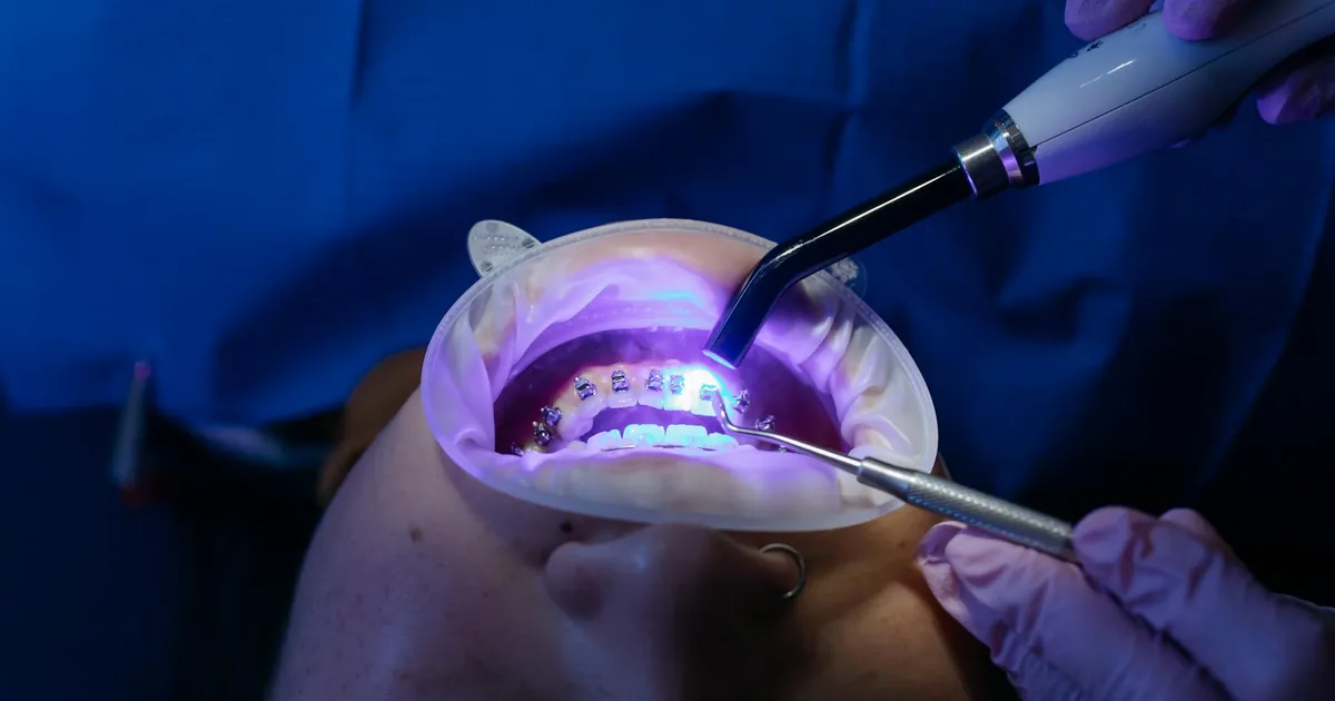 UV light curing dental procedure for teeth whitening and health care.