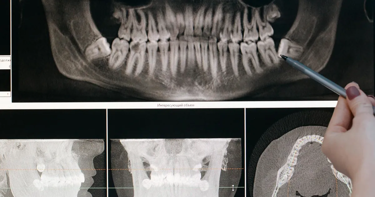 Detailed dental X-ray showing teeth structure highlighted by a pointing pen.