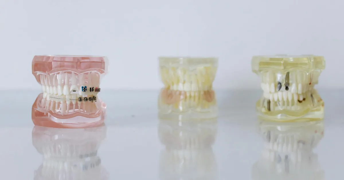 Close-up of dental models displaying braces and dentures for orthodontic education.