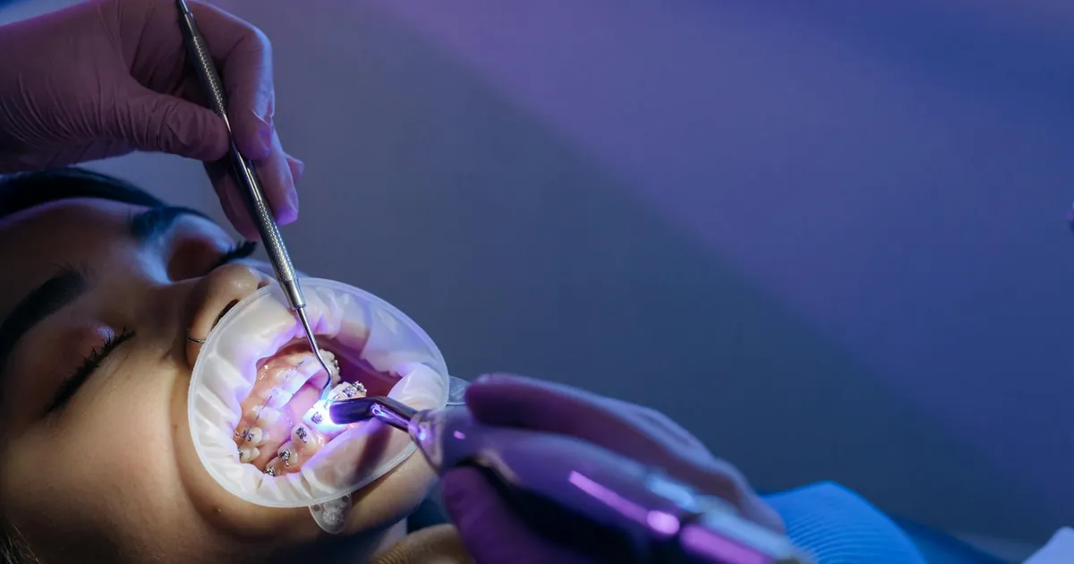 Dental treatment process focusing on orthodontic braces using UV light by a professional.