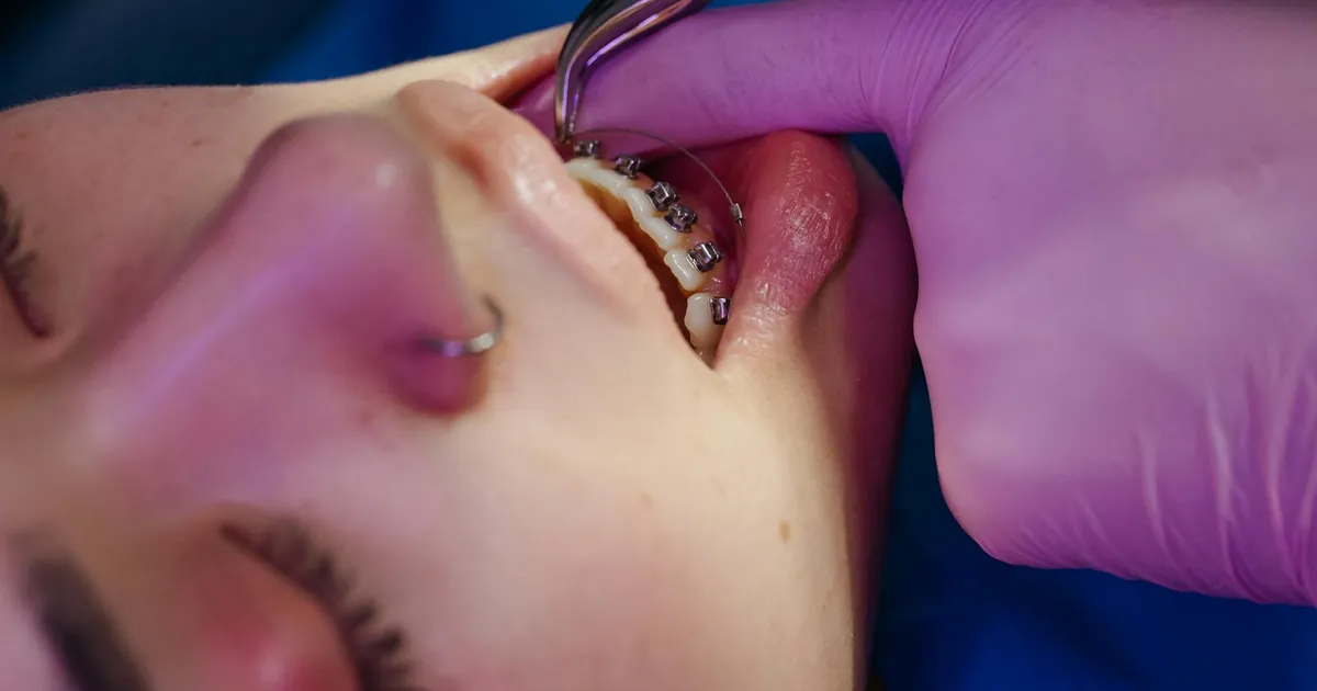 A close-up view of a dental procedure involving braces on a teen.
