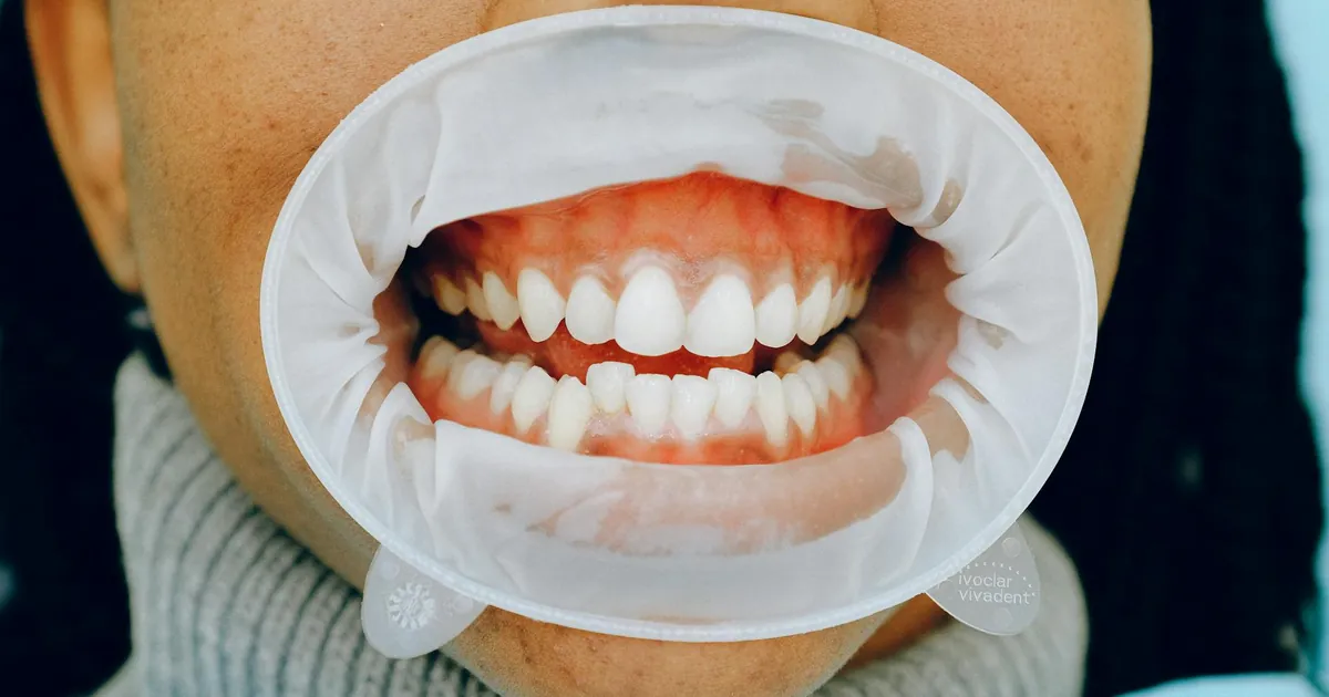 Detailed image of a woman's open mouth during a dental checkup using a cheek retractor.