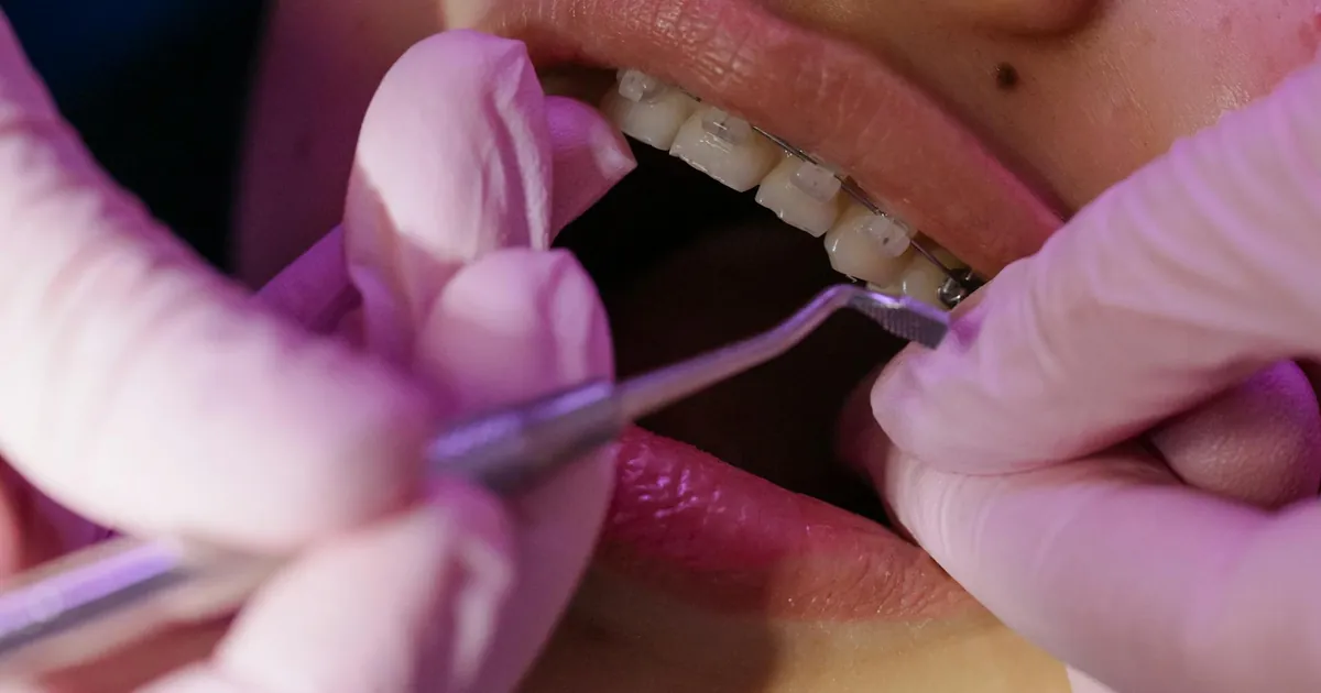 A dentist carefully examines orthodontic braces during a dental procedure.