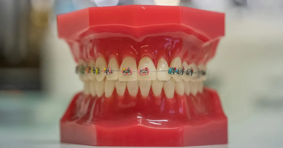 Model of human teeth with colorful braces, showcasing dental care and orthodontics.